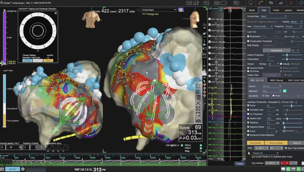 Breakthrough Atrial Fibrillation Ablation Procedures Performed by Elkardia Cardiologists