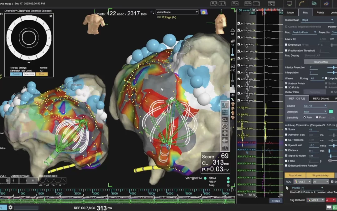 Przełomowe zabiegi ablacji migotania przedsionków wykonane przez kardiologów z Elkardii