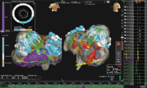ablacja serca lublin pfa ablacja arytmii serca